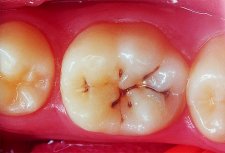 Cárie nos dentes