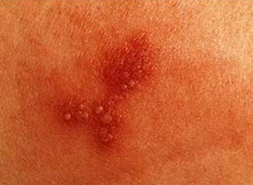 Herpes genital é transmitida no banheiro