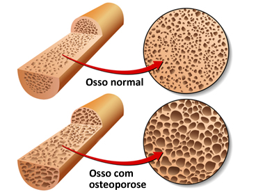 Demonstração gráfica da osteoporose