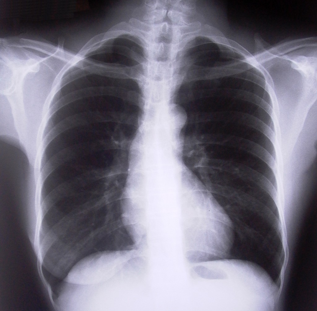 tuberculose é transmitida pelo ar por pessoas infectadas
